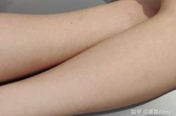 激光脱毛后多久可以怀孕