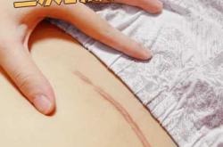 剖腹产间隔一年能生吗