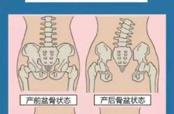 产后如何评估盆底肌力