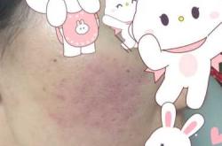 备孕时能吃过敏药吗