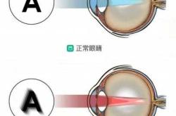 婴儿散光怎么矫正