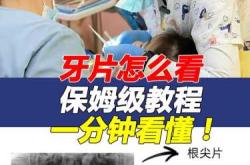 备孕前是否需拔智齿补牙