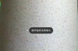 男性激光脱毛后能备孕吗