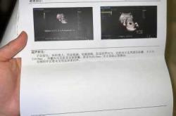 孕十九周孕反结束了吗