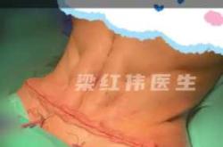 剖腹产后肚子下垂怎么办