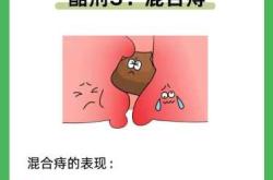 产后会得痔疮吗