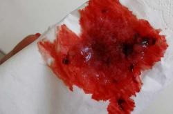 产后恶露有哪些异常情况