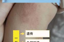月子里宝宝长湿疹怎么办