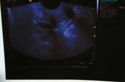 姨妈血黑色能怀孕吗