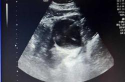 dr平扫片影响备孕吗