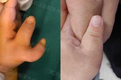 新生儿多指是怎么引起的