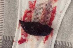 产后20多天还有血性恶露正常吗