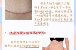 剖腹产刀口崩裂怎么办
