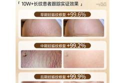 产后妊辰纹能去除吗