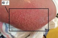 新生儿尿不湿过敏有啥症状