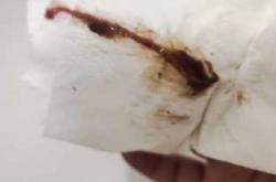 孕反后有血正常吗