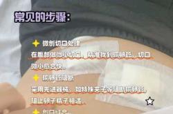 女人剖腹产同时结扎好吗