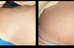 老公孕反妊娠纹图片哪里找