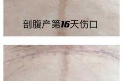 剖腹产伤口多久会开始变红