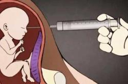 引产后为何会出现肛门痉挛