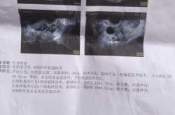 备孕雌二醇125正常吗