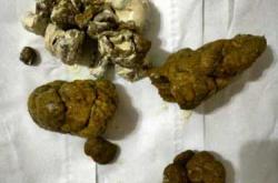 产后大便带脓怎么办