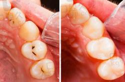 备孕能补牙治鼻炎吗