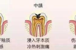 产后多久可以开始刷牙
