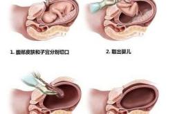 剖腹产露肚子开刀是怎样的