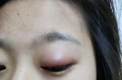 剖腹产针眼流脓是怎么回事