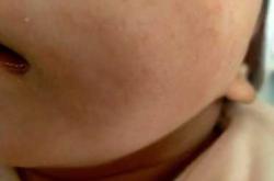 婴儿喝奶粉过敏有什么症状