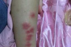 新生儿腿上有红疙瘩是咋回事