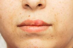 婴儿脸上疱疹咋回事