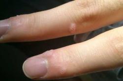 手上长疣影响备孕怀孕吗