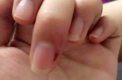 为什么产后手指缝疼