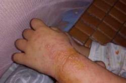 男打退烧针影响备孕吗