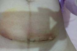 剖腹产后两个月伤口痛正常吗
