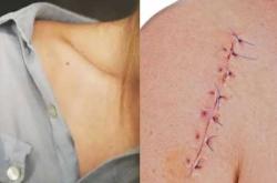 产后下面缝针多久能恢复