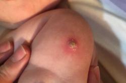 婴儿毒刺是什么