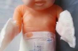 新生儿阴囊水肿是怎么回事