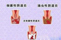 滴虫性阴道炎能正常怀孕吗