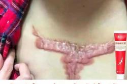 剖腹产小疙瘩如何消除