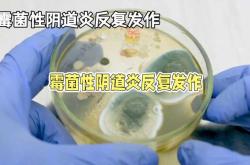 备孕女性霉菌危害大不大