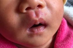 新生儿有血管瘤要紧吗