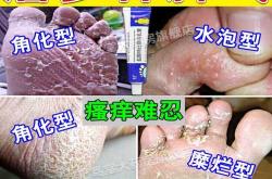 怀孕脚痒能涂药膏吗