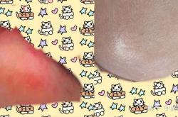 新生儿屁股烂了咋办