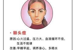 产后脸上长痘痘是怎么回事