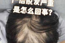 产后为啥会脱发