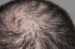 婴儿后脑勺出汗多为何