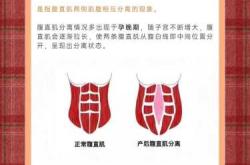 产后腹直肌分离两指咋办